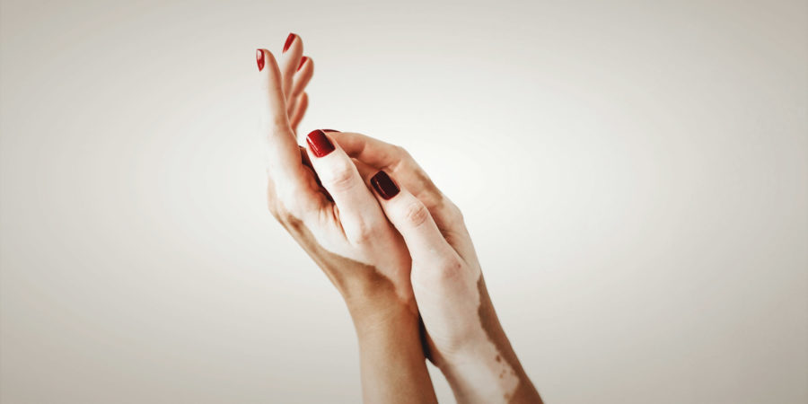Dra. Alessandra Zawadzki - Vitiligo: O que é? É contagioso? Prejudica a saúde?